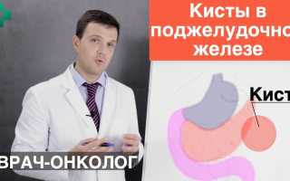 Киста поджелудочной железы: симптомы, лечение, народные средства, видео