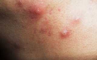 Почему во время беременности появляются прыщи и как с ними справиться