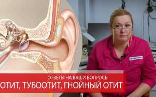 Отит среднего уха: симптомы и лечение, советы врачей, народные средства, видео