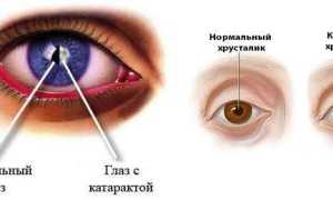 Катаракта – особенности течения болезни и эффективное лечение для пациентов