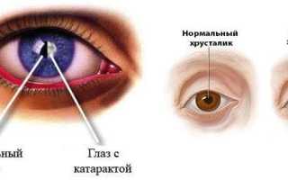 Катаракта – особенности течения болезни и эффективное лечение для пациентов