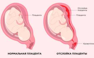 Как сохранить малыша при преждевременной отслойке плаценты: советы и рекомендации