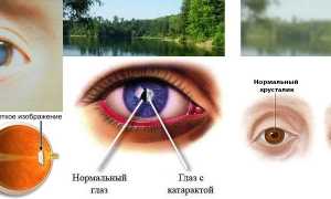 Заболевание “Катаракта” у пожилых людей: лечение разными методами и профилактика