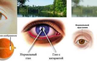 Заболевание “Катаракта” у пожилых людей: лечение разными методами и профилактика