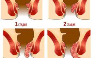 Виды и стадии геморроя, лечение — медицина и домашние средства
