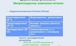 Диабетическая ретинопатия: причины возникновения, лечение и профилактика