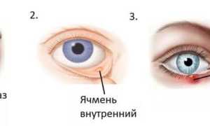 Что делать с ячменем начинающимся – когда начинается на глазу и как его лечить