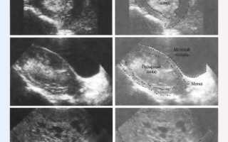 Пузырный занос на ранних сроках беременности: причины и последствия