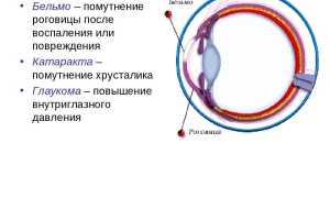 Бельмо и катаракта: причины возникновения и лечение глазных заболеваний