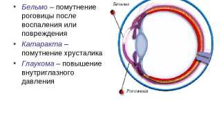Бельмо и катаракта: причины возникновения и лечение глазных заболеваний