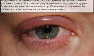 Почему отекают веки над глазами по утрам у женщин: причины и советы
