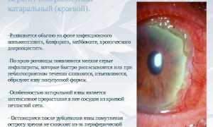 Кто подвержен краевому кератиту? Узнайте больше о рисках.