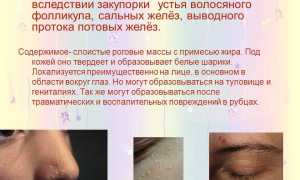 Как бороться с милиумами на лице: советы и рекомендации