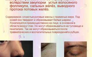 Как бороться с милиумами на лице: советы и рекомендации