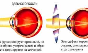 Чем опасна и как лечится дальнозоркость у детей? Полезные советы