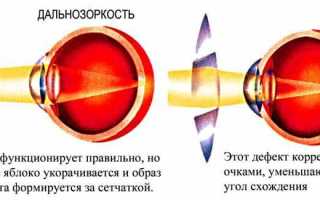 Чем опасна и как лечится дальнозоркость у детей? Полезные советы
