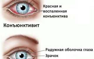 Как быстро вылечить конъюнктивит в домашних условиях