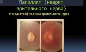Неврит зрительного нерва: симптомы патологии и их последствия