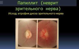 Неврит зрительного нерва: симптомы патологии и их последствия