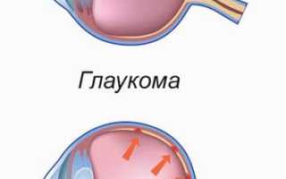 Лекарства от глаукомы: эффективные методы лечения