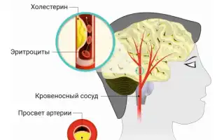 Атеросклероз сосудов мозга и ног: особенности заболевания, лечение