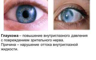 Эффективные глазные капли при глаукоме для улучшения зрения