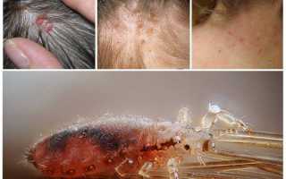 Какие могут быть в волосах головы человека паразиты