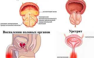 Уретрит и баланопостит