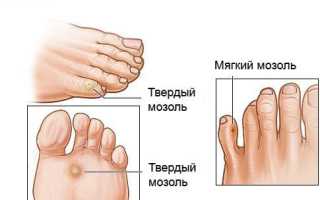 Болезни стопы ног: симптомы и лечение, виды и признаки заболеваний