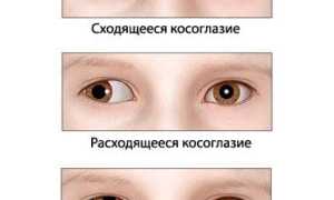 Причины появления косоглазия у детей: важные аспекты и рекомендации
