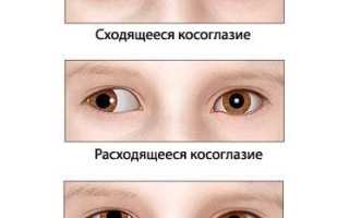 Причины появления косоглазия у детей: важные аспекты и рекомендации