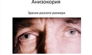 Разный размер зрачков у взрослого – причины анизокории и их последствия