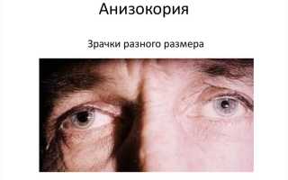 Разный размер зрачков у взрослого – причины анизокории и их последствия