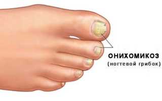 Методы лечения онихомикоза во время беременности, лекарственные и народные средства для здоровья