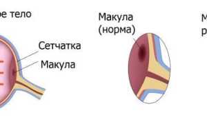 Макулярный разрыв сетчатки: причины и последствия
