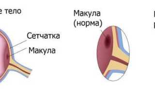 Макулярный разрыв сетчатки: причины и последствия