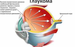 Глаукома – как лечить: методы и рекомендации для пациентов