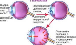 Глаукома – признаки и симптомы: лечение, как выглядит заболевание и его последствия