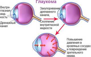 Глаукома – признаки и симптомы: лечение, как выглядит заболевание и его последствия