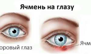 Ячмень – симптомы и первые признаки, как проявляется и начинается на глазу, у взрослых и детей