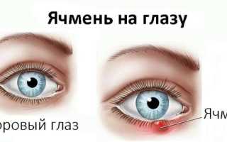 Ячмень – симптомы и первые признаки, как проявляется и начинается на глазу, у взрослых и детей