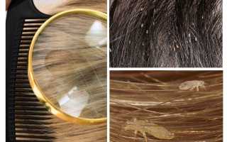 Когда нужно проводить обработку головы при педикулезе