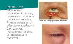 Как появляется ячмень на глазу – откуда берется и как проходит, причины и лечение