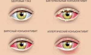 Сколько лечится конъюнктивит у взрослых, как долго проходит, и что важно знать