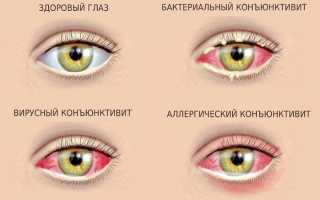 Сколько лечится конъюнктивит у взрослых, как долго проходит, и что важно знать