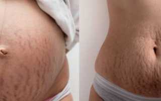 Как убрать растяжки после родов? Натуральные домашние средства