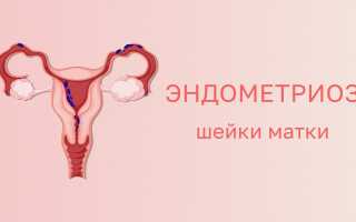 Эндометриоз матки: диагностика и лечение, медицина и народные средства, видео