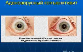 Конъюнктивит по МКБ-10 код – аденовирусная инфекция, вирусный: симптомы и лечение