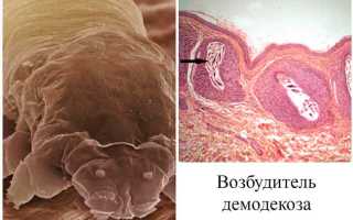 Что такое “Демодекоз век” и как с ним бороться?