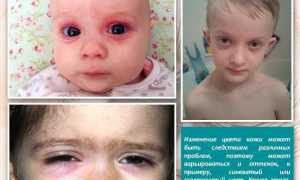 У ребенка круги под глазами красные и розовые пятна – причины и рекомендации